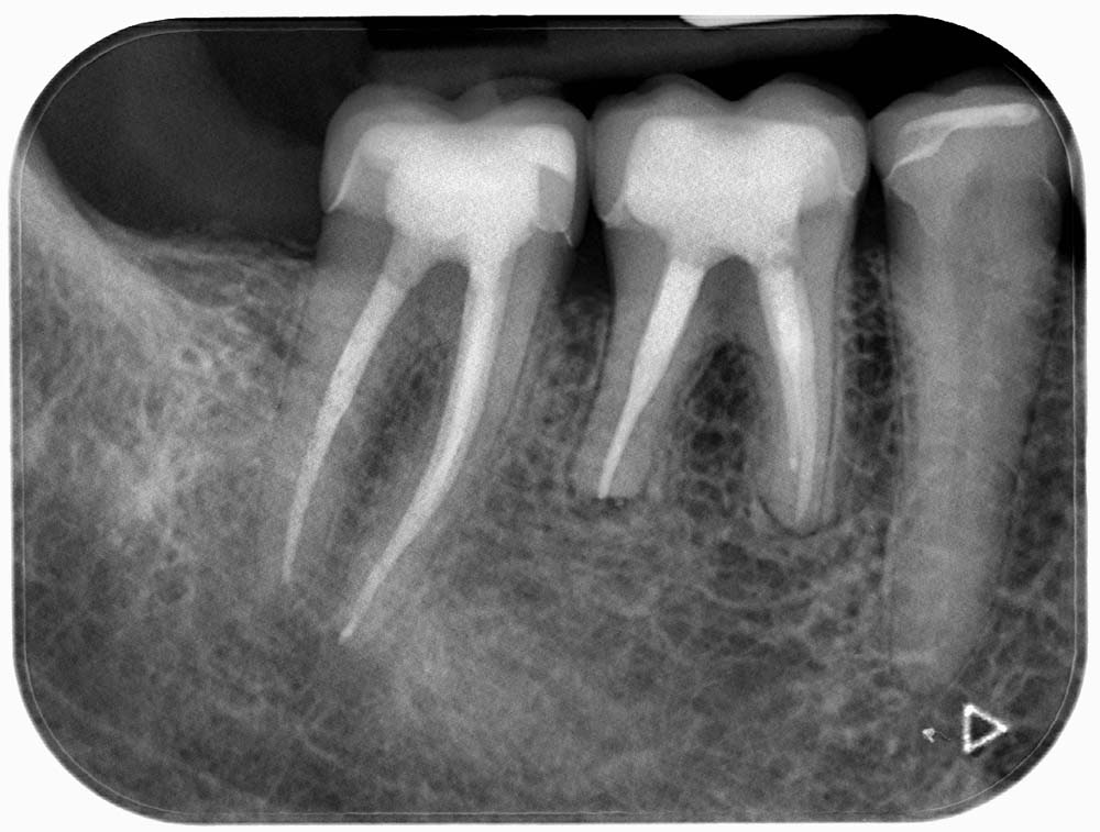 Röntgenbild einer Zahnbehandlung